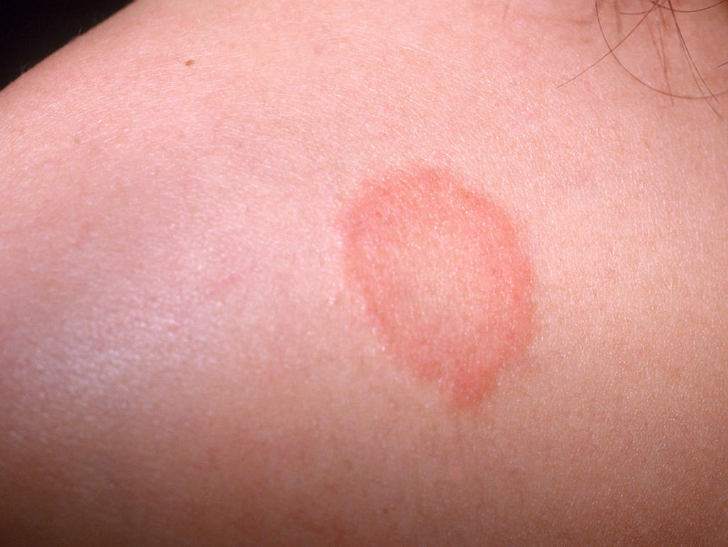 Featured image of post Early Stage Ringworm Rash On Baby